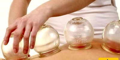 People Who Should Never Undergo Cupping Therapy