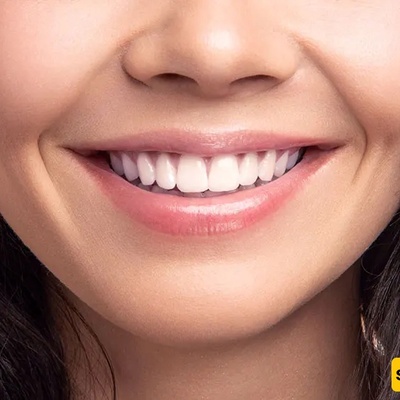 What Are the Side Effects of Dental Composite Bonding and Is It Harmful to Your Teeth?