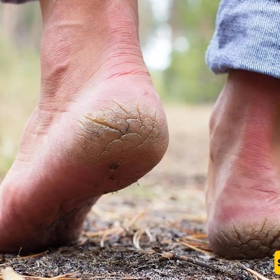 A Deficiency in These 3 Vitamins Can Cause Cracked Heels
