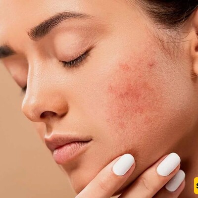 The Ultimate Guide to Banishing Under-Skin Pimples