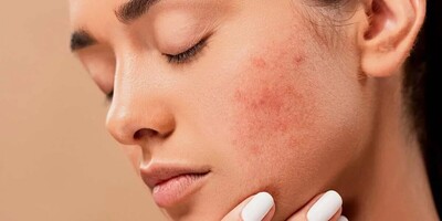 The Ultimate Guide to Banishing Under-Skin Pimples