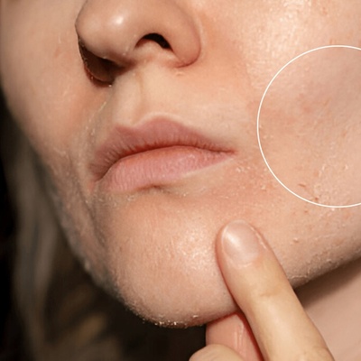 A Skin Sign That Becomes More Noticeable With Dehydration