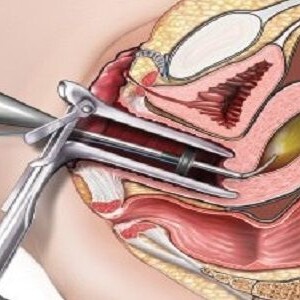Types of Dilation and Curettage and Reasons for Performing It