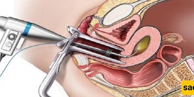 Types of Dilation and Curettage and Reasons for Performing It