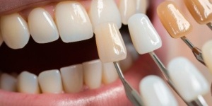 The Secret Revealed by Tooth Color: Which Stain Color Is the Most Dangerous?
