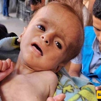 Two More Children In Gaza Die Of Israeli-Enforced Starvation
