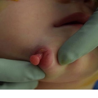 A Baby Born With Two Mouths in the United States + Images
