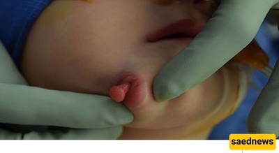 A Baby Born With Two Mouths in the United States + Images