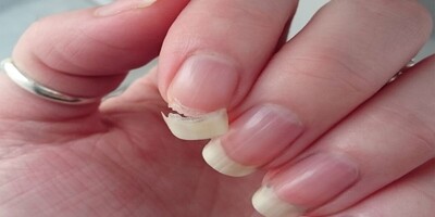 Why Are Your Nails So Brittle? Discover the 10 Key Causes