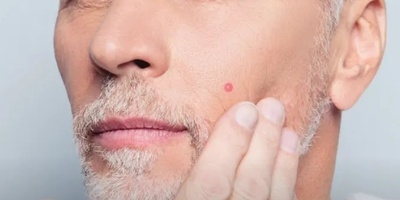 A Small Spot on the Skin That Should Not Be Ignored