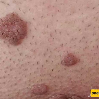 Genital Warts: A Silent, Contagious Condition Caused by the HPV Virus