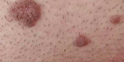 Genital Warts: A Silent, Contagious Condition Caused by the HPV Virus