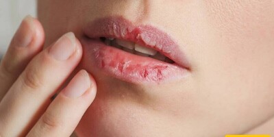 8 Effective Tips to Prevent Dry and Chapped Lips in Autumn / Home Remedies for Chapped Lips: Make a Honey and Jojoba Blend