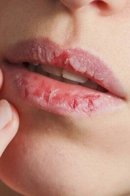 8 Effective Tips to Prevent Dry and Chapped Lips in Autumn / Home Remedies for Chapped Lips: Make a Honey and Jojoba Blend