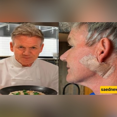 Gordon Ramsay Shares Photo After Removing Skin Cancer (Please Don’t Forget Your Sunscreen)