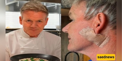 Gordon Ramsay Shares Photo After Removing Skin Cancer (Please Don’t Forget Your Sunscreen)