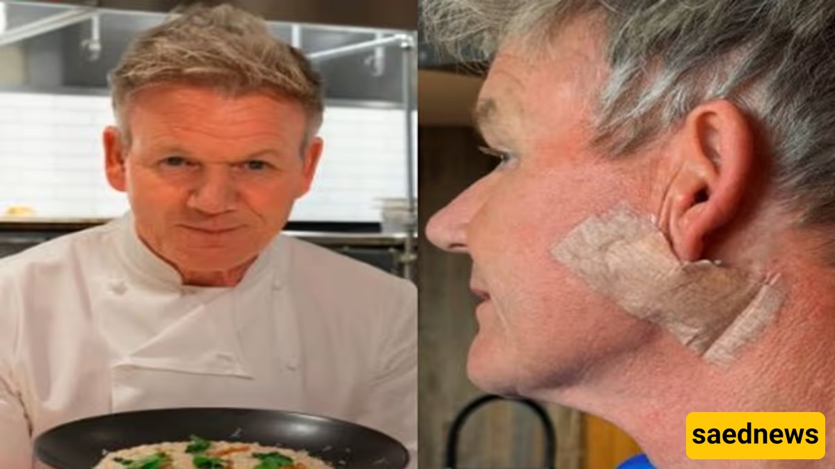 Gordon Ramsay Shares Photo After Removing Skin Cancer (Please Don’t Forget Your Sunscreen)