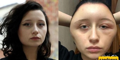 Counterfeit Hair Dye Leaves Young Woman Facing Serious Consequences