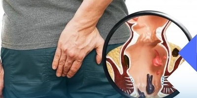 What Are Bleeding Hemorrhoids and Why Do They Occur?