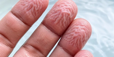Why Do Our Fingers Wrinkle in Water?