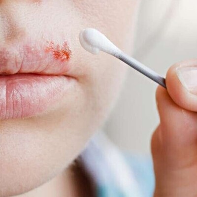The Best Beneficial and Harmful Foods for Cold Sores: A Comprehensive Nutrition Guide for Faster Healing