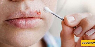 The Best Beneficial and Harmful Foods for Cold Sores: A Comprehensive Nutrition Guide for Faster Healing