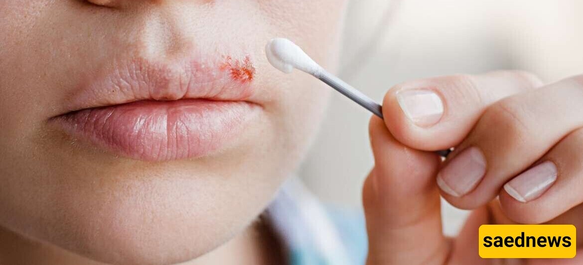 The Best Beneficial and Harmful Foods for Cold Sores: A Comprehensive Nutrition Guide for Faster Healing