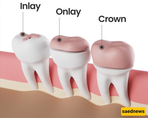 The Complications and Problems That May Occur When Filling a Tooth.