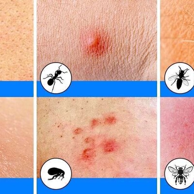 Effective Home Remedies for Relieving and Treating Flea Bites Itching in the Fastest Time.