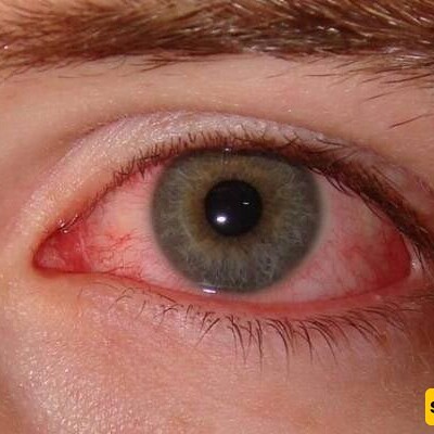 Side Effects And Uses of Bactymaid Eye Drops...