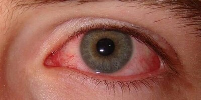 Side Effects And Uses of Bactymaid Eye Drops...