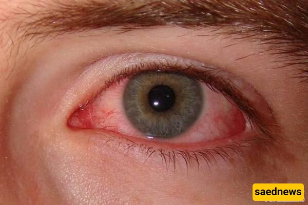 Side Effects And Uses of Bactymaid Eye Drops...