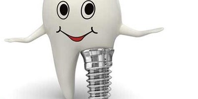 Dental Implants for Front Teeth and Important Considerations