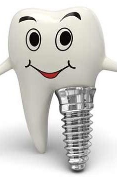 Dental Implants for Front Teeth and Important Considerations
