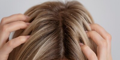 Can Dandruff be Cured for Good? The Truth Revealed