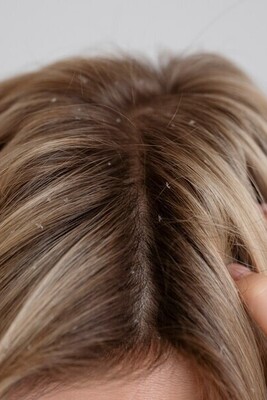 Can Dandruff be Cured for Good? The Truth Revealed