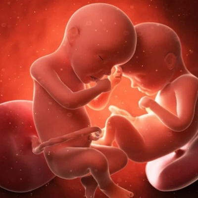 Fetus Emerging From the Head of Its Twin Sister Inside the Mother’s Womb + Ultrasound Image