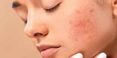 Home Remedies for Acne with Natural and Effective Ingredients / Using Lemon as a Home Remedy for Acne