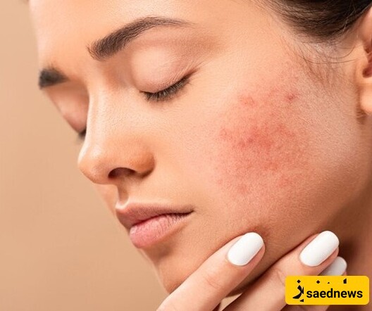 Home Remedies for Acne with Natural and Effective Ingredients / Using Lemon as a Home Remedy for Acne