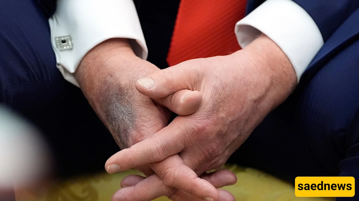 Trump Bruise