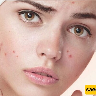 Struggling with Acne? 15 Effective Tips To Prevent Breakouts!