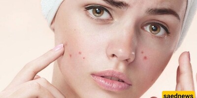 Struggling with Acne? 15 Effective Tips To Prevent Breakouts!