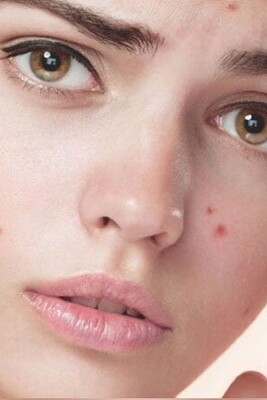 Struggling with Acne? 15 Effective Tips To Prevent Breakouts!
