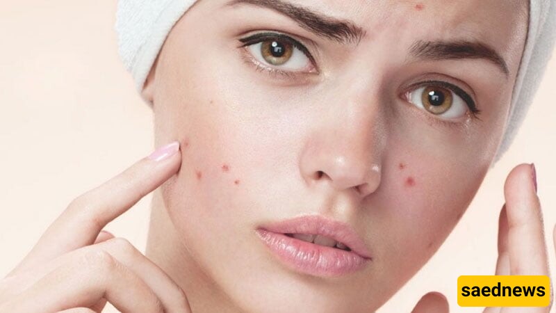 Struggling with Acne? 15 Effective Tips To Prevent Breakouts!