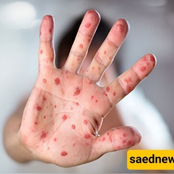 Measles Outbreak in Bangladesh Has Claimed the Lives of 500 Children