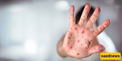 Measles Outbreak in Bangladesh Has Claimed the Lives of 500 Children