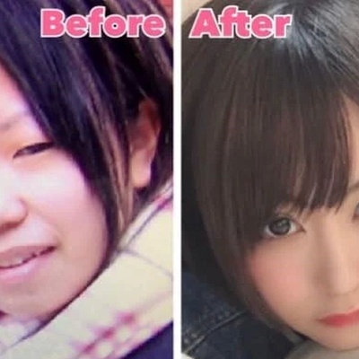 Unbelievable Transformation: Japanese Girl's Stunning Before-and-After Plastic Surgery Journey