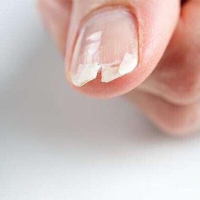 10 Main Causes of Nail Breakage and Thinning / What Factors Cause Nail Fragility? + Solutions and Treatments