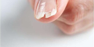 10 Main Causes of Nail Breakage and Thinning / What Factors Cause Nail Fragility? + Solutions and Treatments