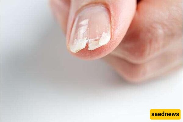 10 Main Causes of Nail Breakage and Thinning / What Factors Cause Nail Fragility? + Solutions and Treatments